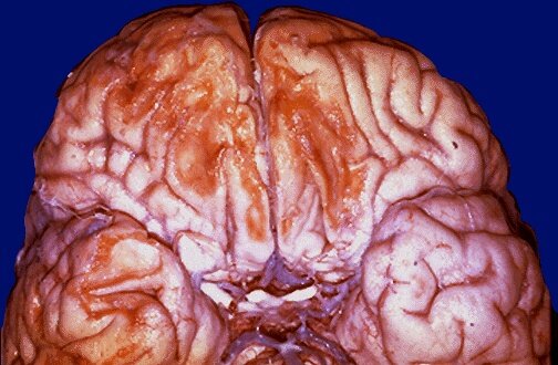 Chronic extensive bilateral orbitofrontal damage to the orbitofrontal cortex from trauma. Note damage to both olfactory bulbs with resultant anosmia