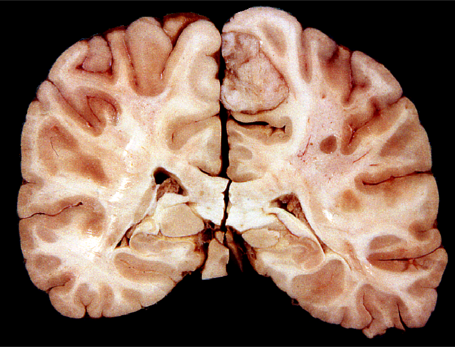 Medial frontal meningioma. Note extra-axial location