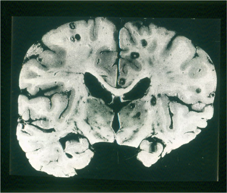 Neurocysticercosis. Note multiple cysts