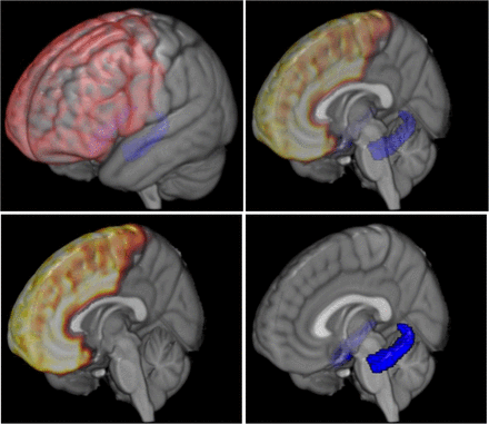 The Neuroscience of Poverty