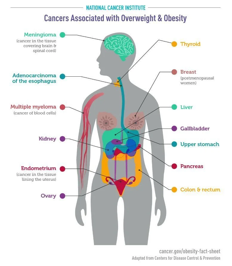 Obesity poised to overtake smoking as leading preventable cause of cancer