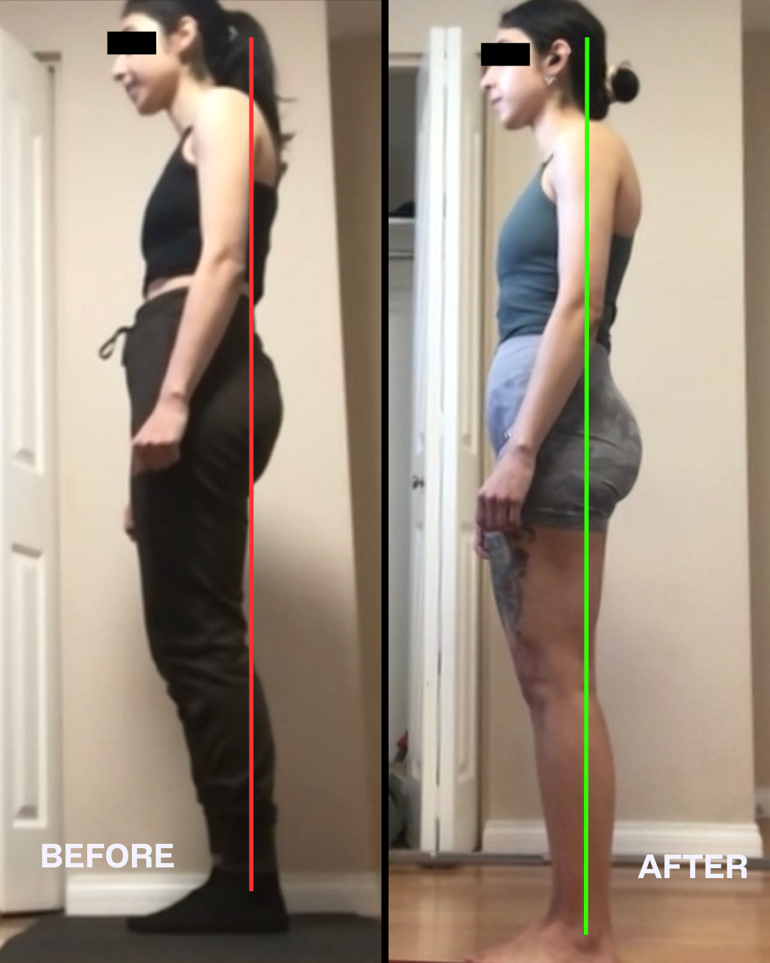 I Wasted Two Years Trying to Fix My Forward Head Posture - Here's What ...