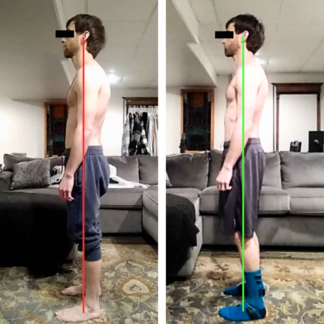 I Wasted Two Years Trying to Fix My Forward Head Posture - Here's What ...