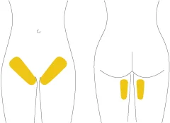 SLA-graphic-treatments-112018_SLA-diagram-basicbikini.jpg