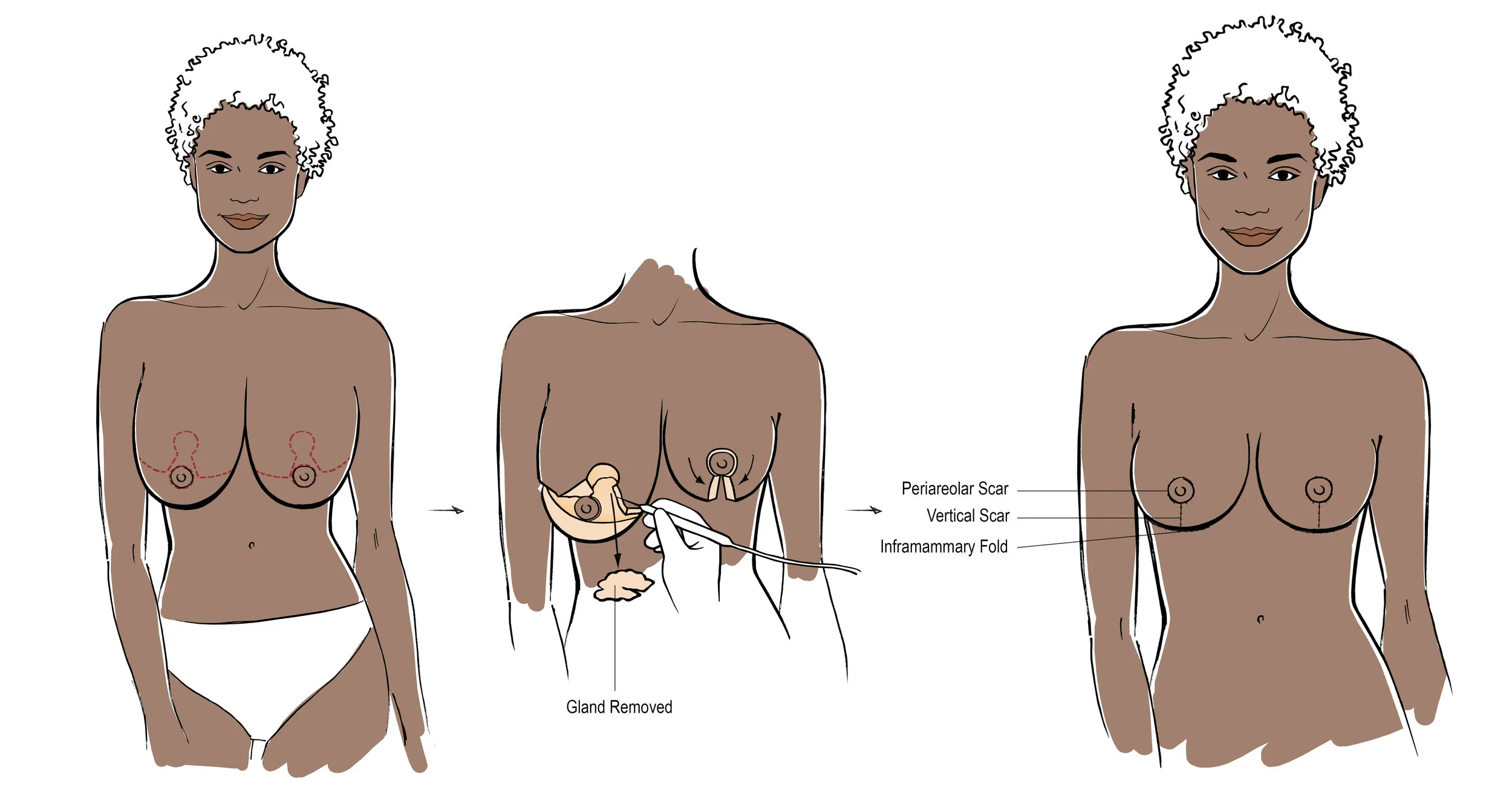 breast reduction, reduction mammaplasty