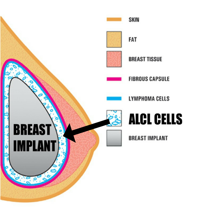 BIA-ALCL