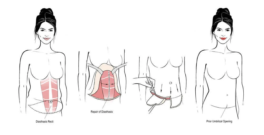 abdominoplasty,+tummy+tuck.jpg