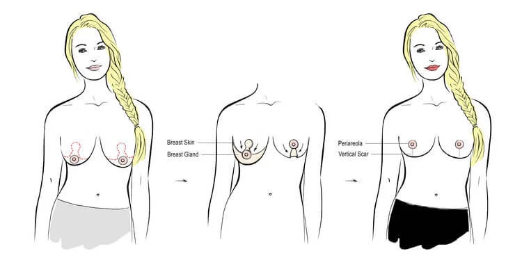 mastopexy,+breast+lift.jpg