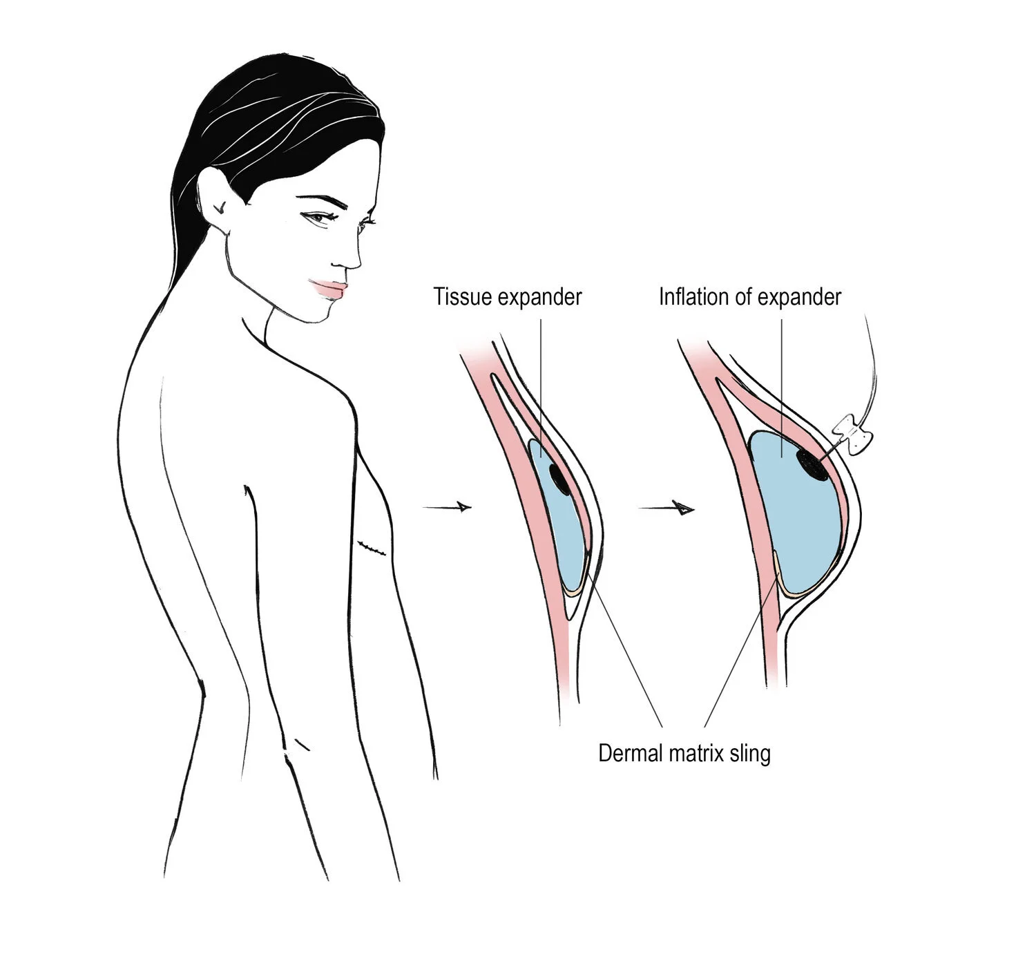 TIssue+Expander+Expansion+Acellular+Dermal+Matrix+ADM+Sling+Breast+Reconstruction.jpeg