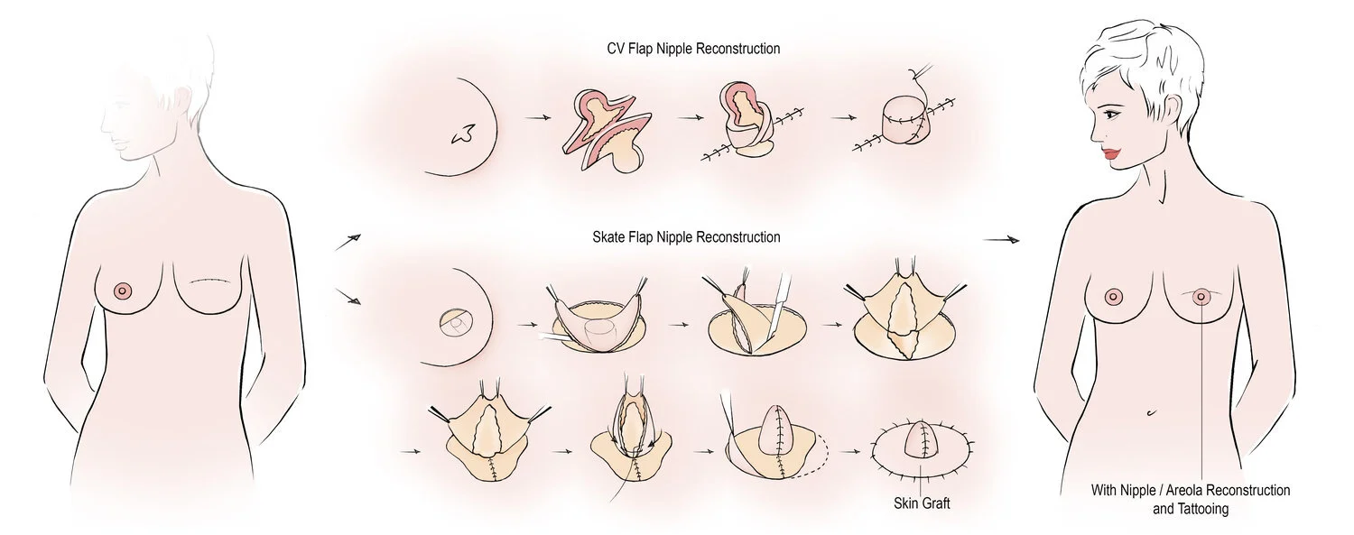 Nipple+Areola+complex+reconstruction,+NAC+reconstruction,+skate+flap,+CV,+flap,+C-V+flap,+Nipple+reconstruction,+Nipple+Tattoo.jpeg