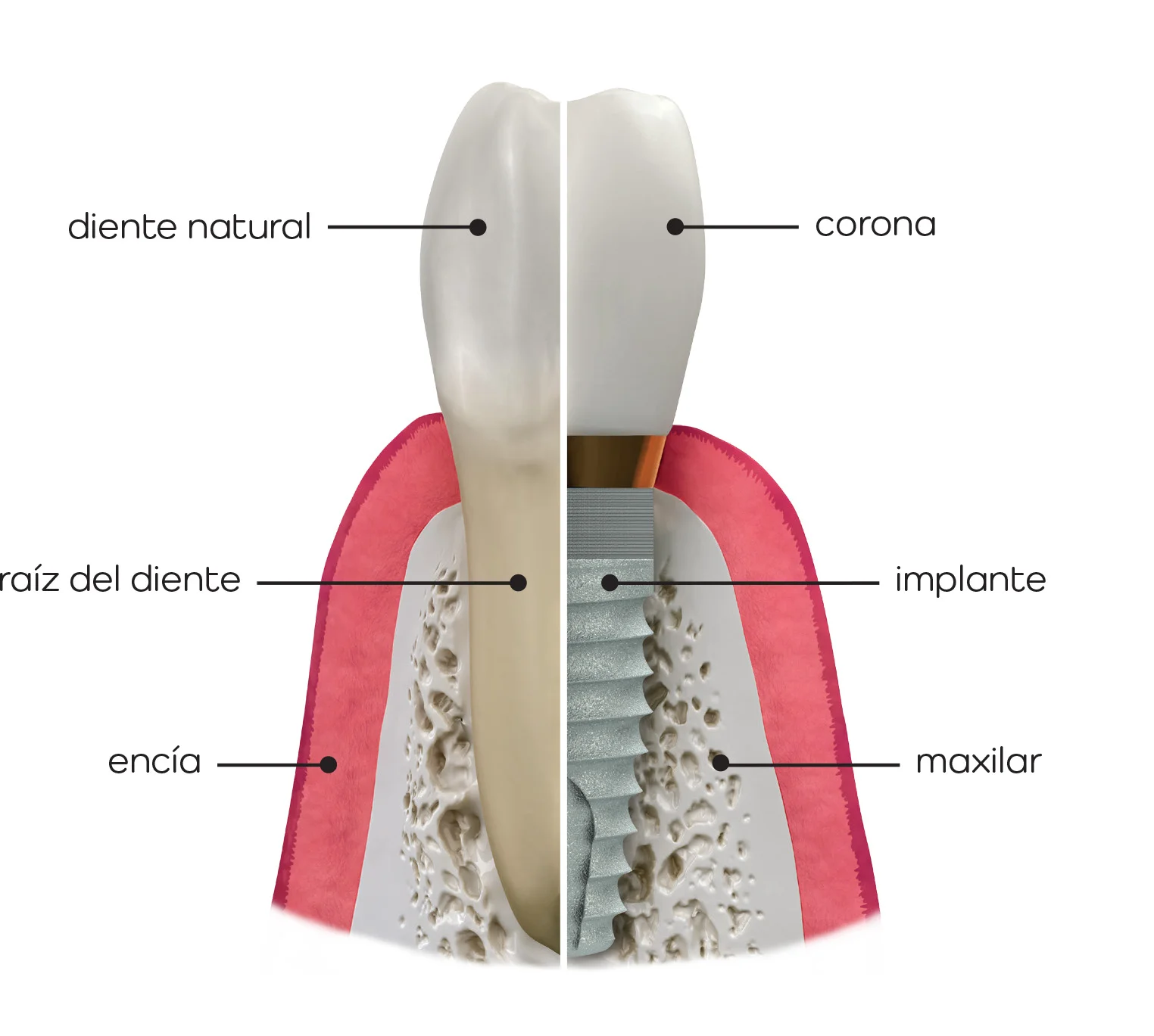 dental_implants.jpg