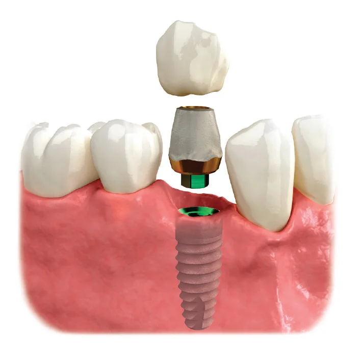 Corona sobre implante dental.