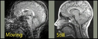 fuzzy-clear brain pix.jpg