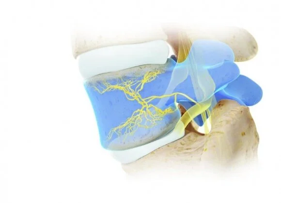 Relievant_Intracept_4K_Still (00935)_CMYK_10in.jpg