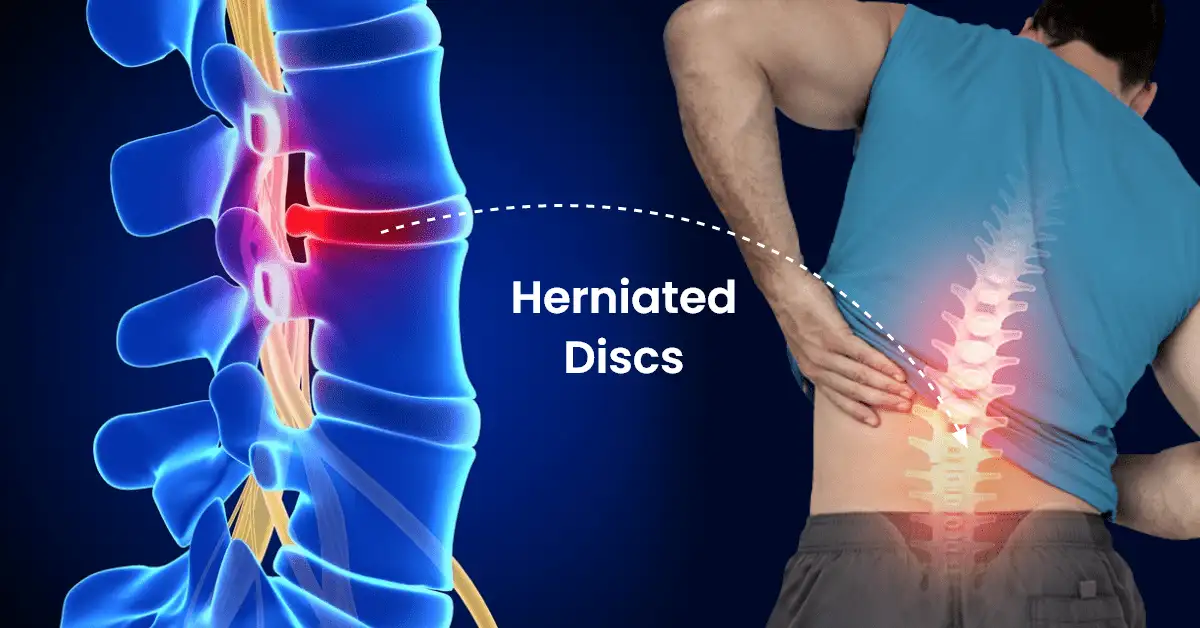 How Long Does A Herniated Disc Take To Heal? — Michael Rock MD