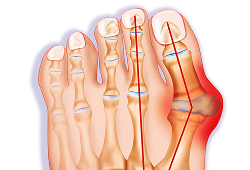 493ss_getty_rm_bunion_illustration-2.jpg