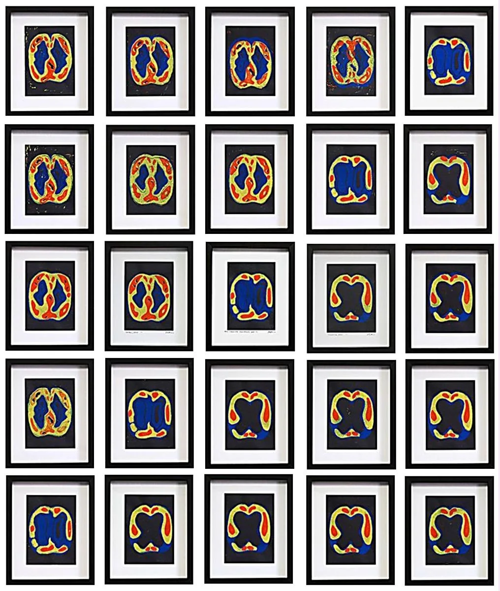 The Progression of Dementia, Irina Teske