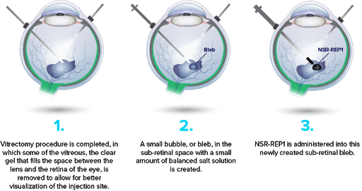 Nightstar’s NSR-REP1 gene therapy requires a 3-step surgical procedure in CHM patients, Credit: Nightstar