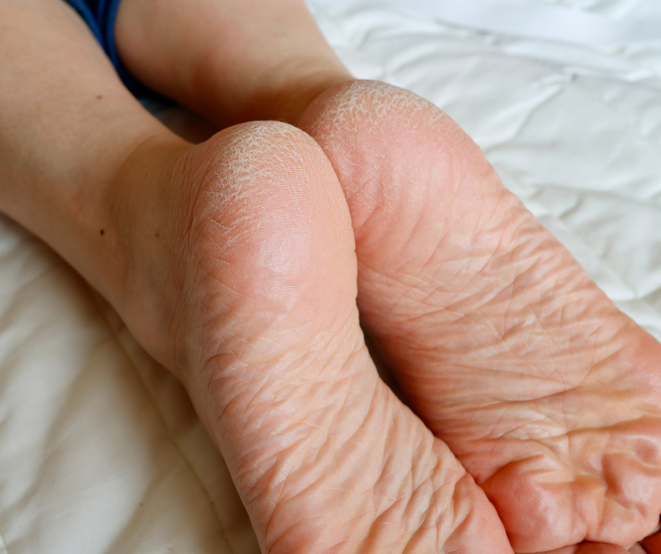 Why Your Heels Crack Every Winter (And What to Do)