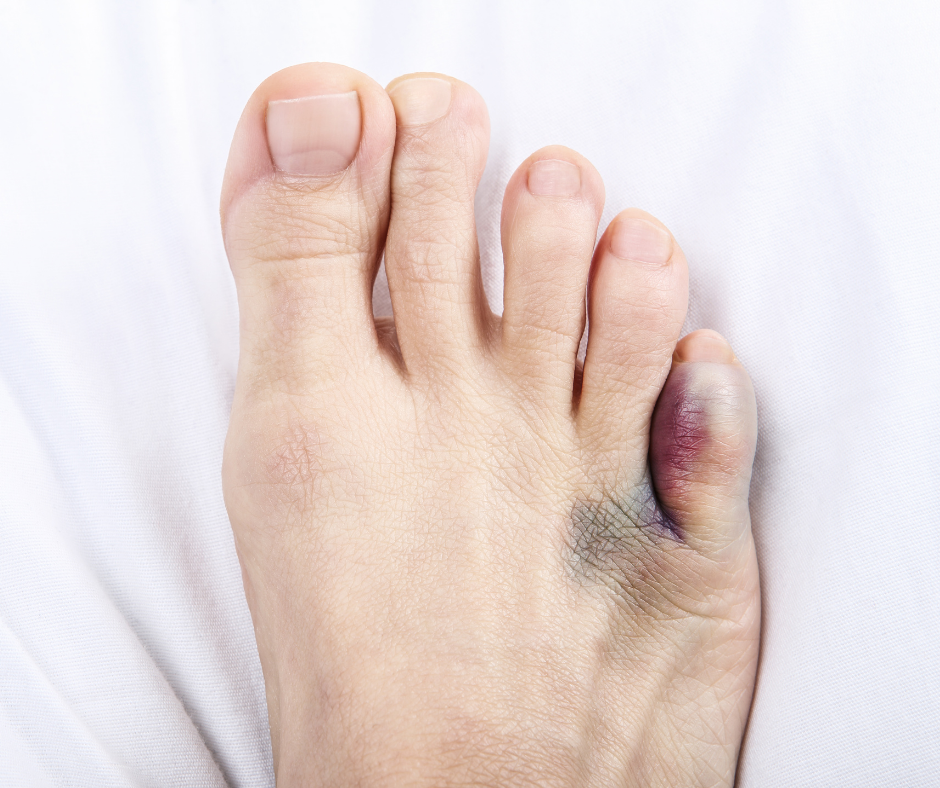 foot with bruised toe