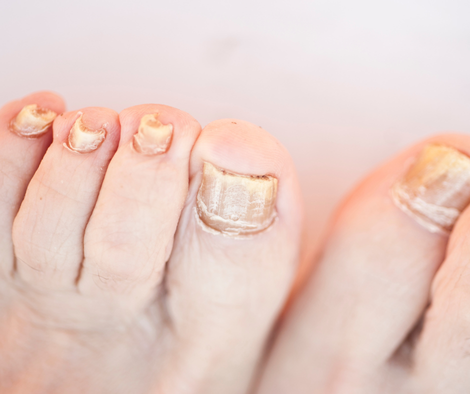 What are the best ways to prevent and treat toenail fungus in athletes? -  FITPAA