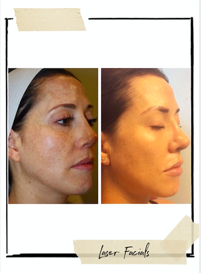 Left is right after I had my daughter Scarlett. Right is after 3 PiccoSure treatments with Sandra.