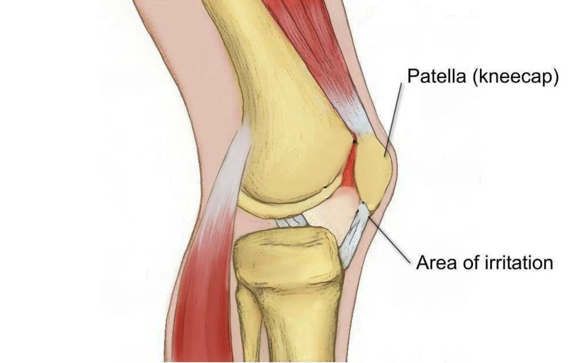 How to avoid ‘Runner’s Knee’