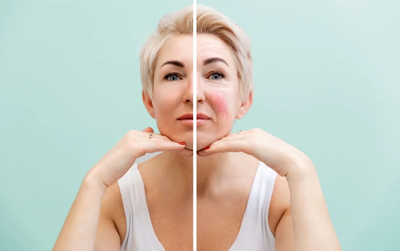Side By Side Of A Woman With Rosacea on her face