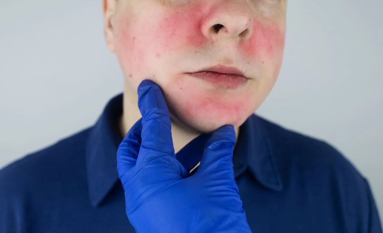 Young man with rosacea on his cheeks