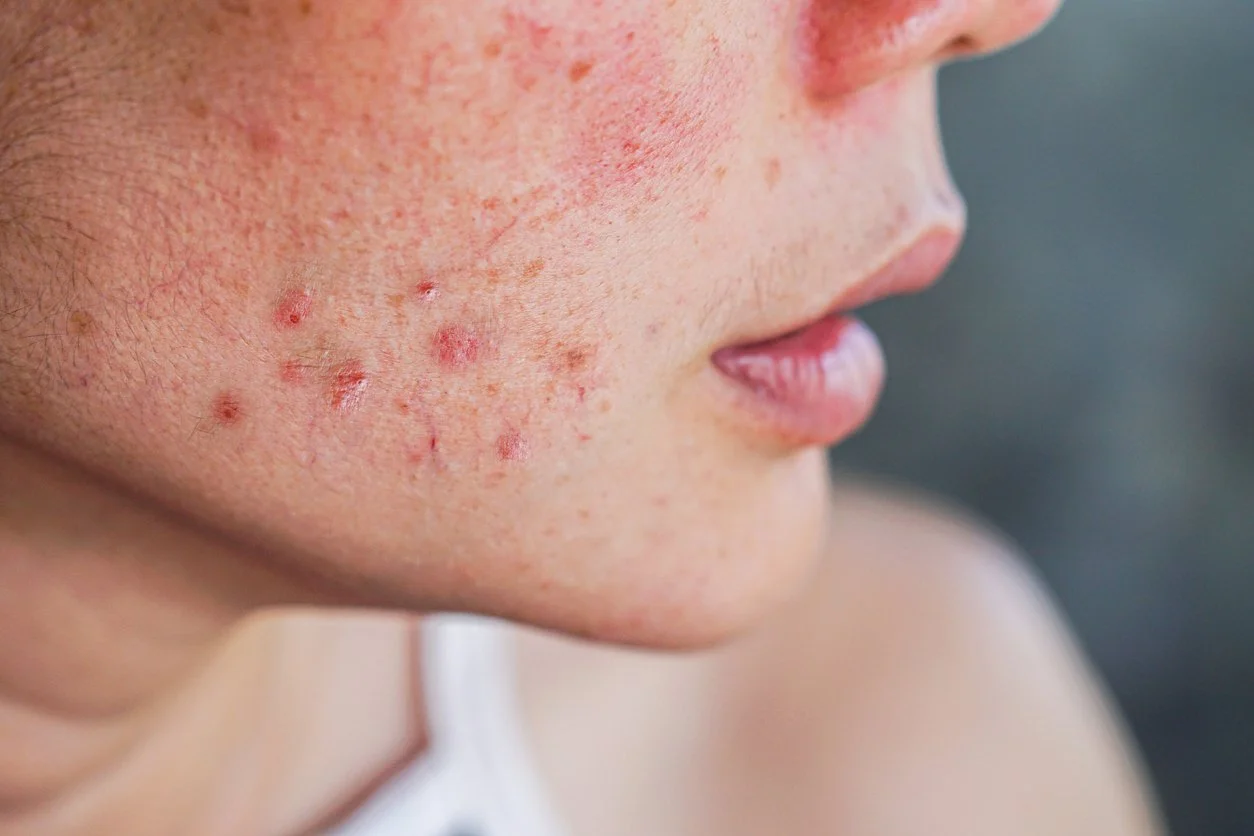 Close up of woman with a skin condition