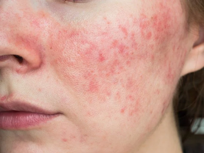 Young female with acne on her skin