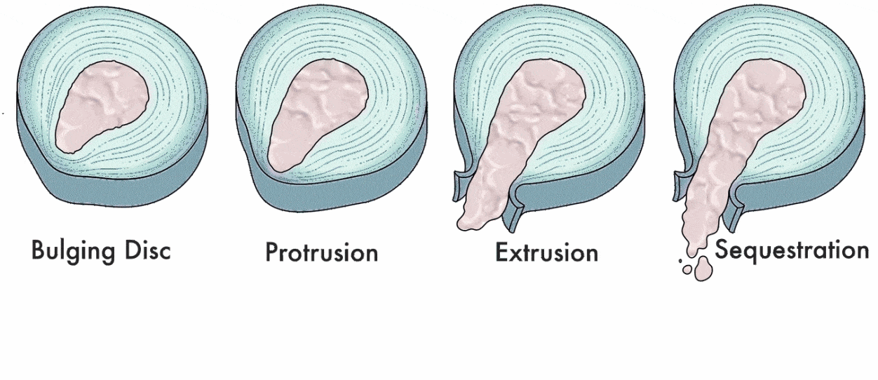 types-of-disc-herniations-and-disc-bulge_integrated-physicians-medical-group_the-integrated-brain-and-spine-center-for-functional-neurology-and-medicine.gif