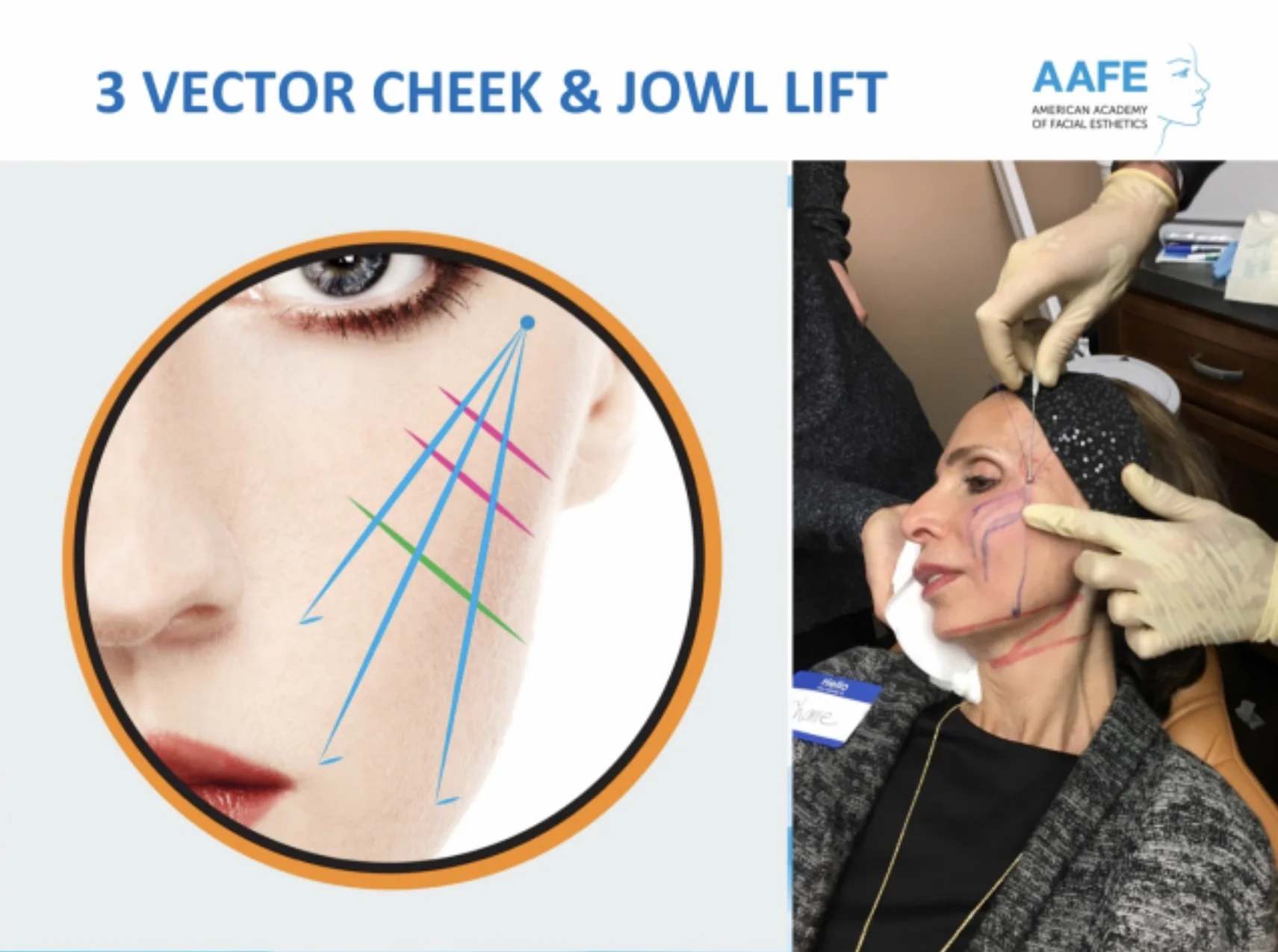 Pdo thread lift dallas indylasopa