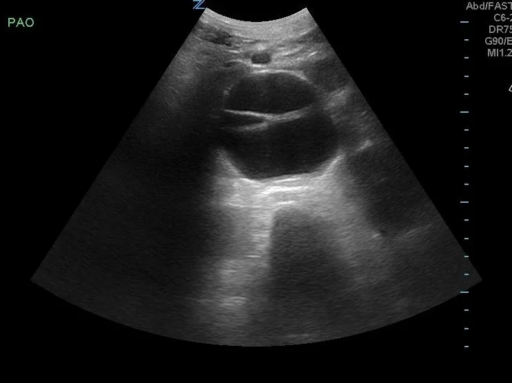 Dissection Detection 