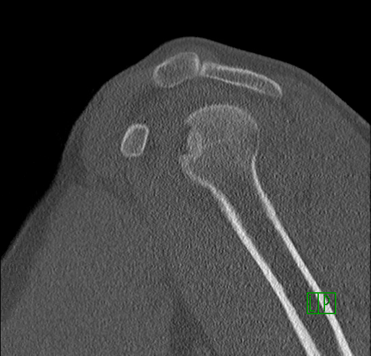3. CT Sagittal -Screen Shot 2020-02-09 at 4.23.37 PM.png