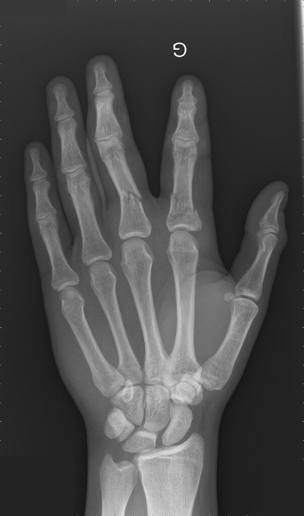 fractures-of-proximal-phalanx.jpg