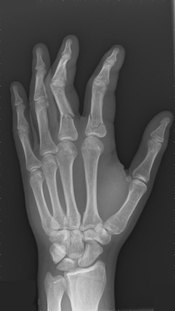 fractures-of-proximal-phalanx (1).jpg