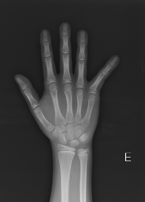 salter-harris-type-ii-fracture-proximal-phalanx-1.png