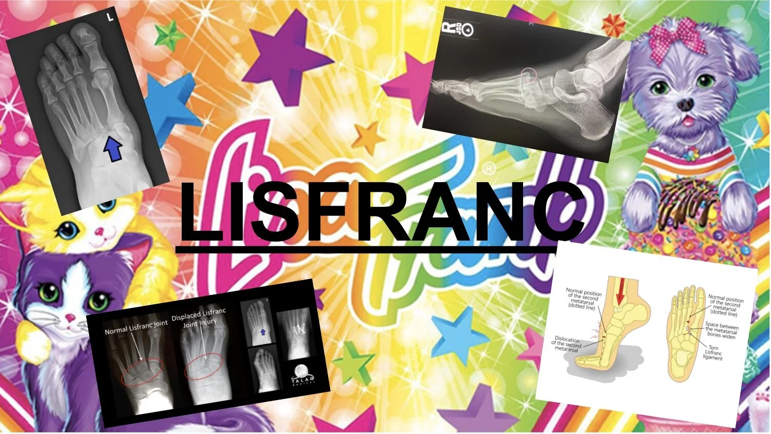 Lisa Frank? No, Lisfranc