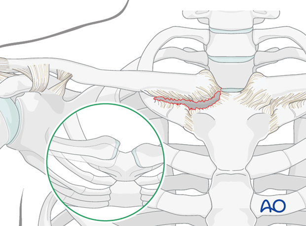 Sternoclavicular Joint Dislocation