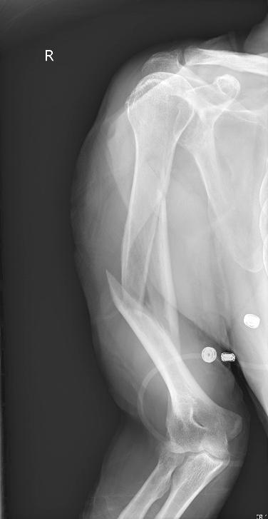 humeral shaft fracture pre AP 1 copy.png