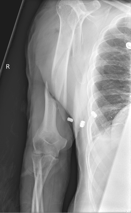humeral shaft fracture pre lateral 2 copy.png