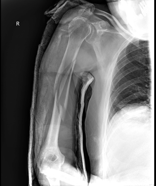 humeral shaft fracture post AP 1.png