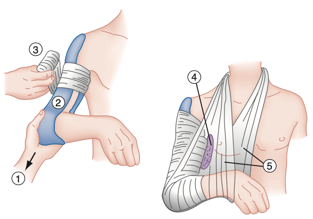 Humeral Shaft Fracture