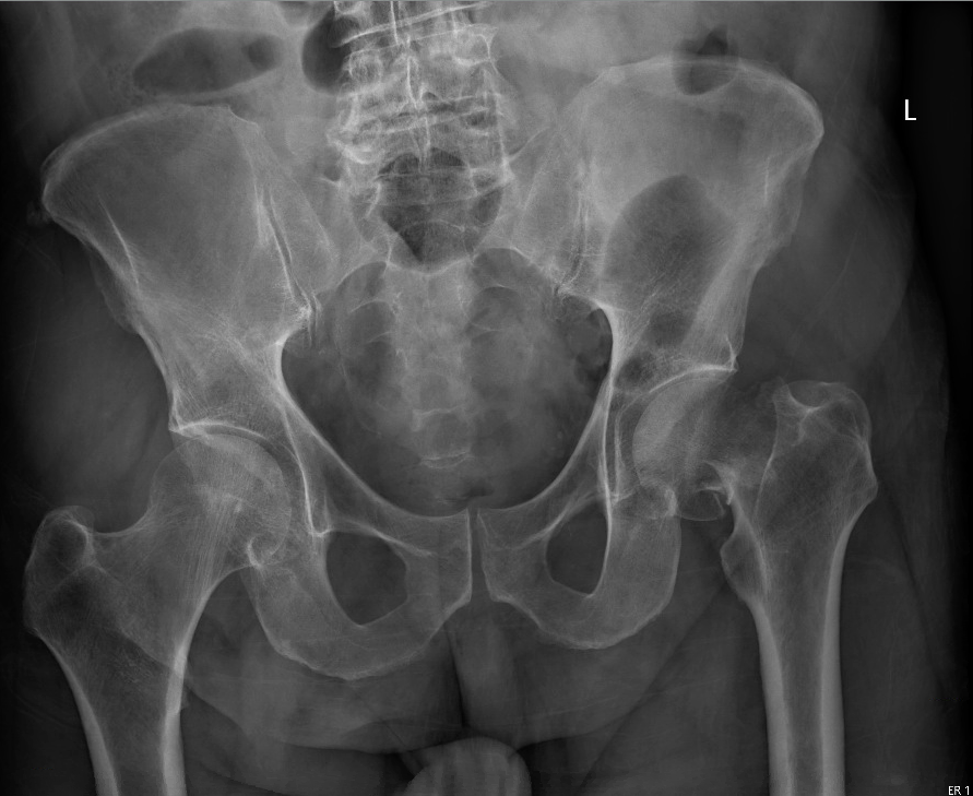 femoral neck fracture 2a.png