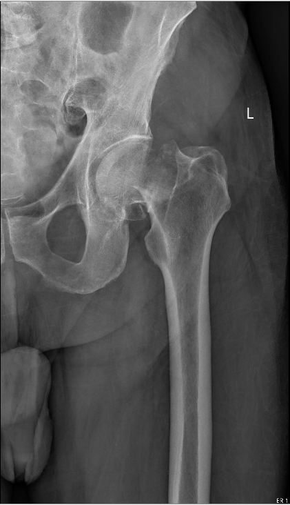 femoral neck fracture 2b.png