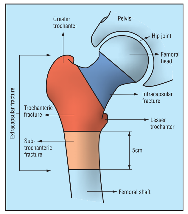Hip Fractures