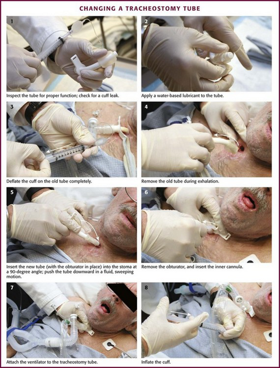 Tricks of the Trach — Kwak Talk