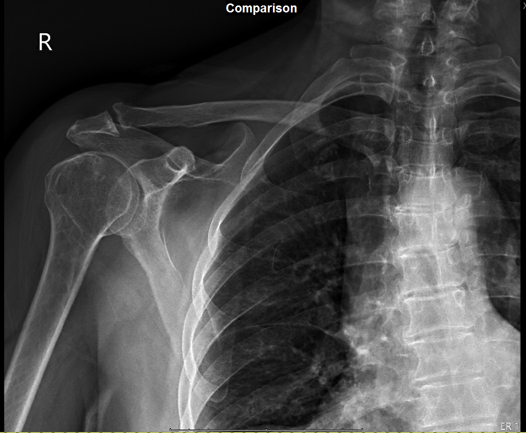 Inferior Shoulder Dislocation Post AP 1.png