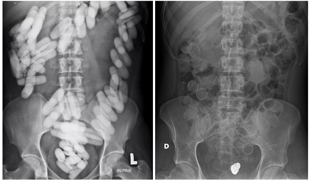 Body Packers and Body Stuffers; Recognizing and Managing Concealed Drug Ingestions